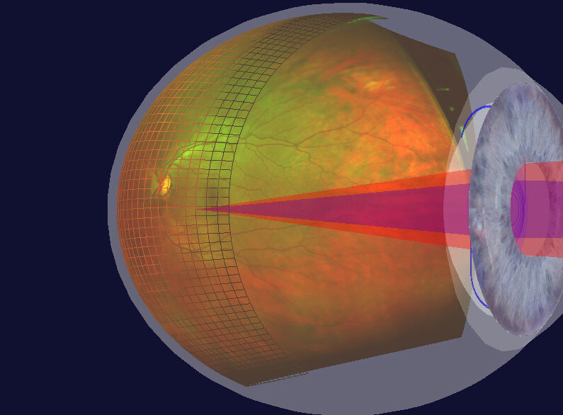 Retinal Imaging optomap 3D eye services